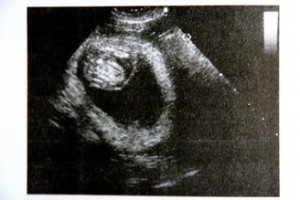 Просвет матки с месячным эмбрионом